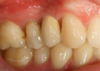 Zahnimplantat mit Zahnkrone