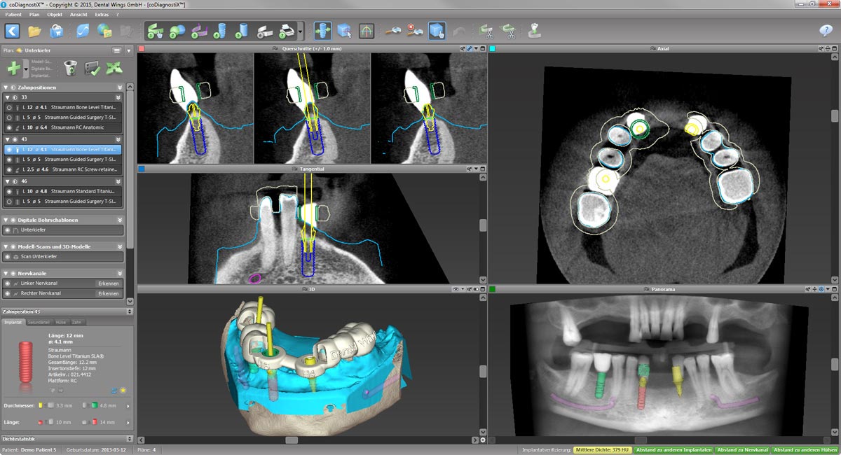 Der Einsatz der coDiagnostiX-Planungssoftware bei der implantatprothetischen Behandlung